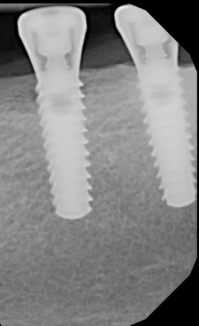 Tapered SwissPlus view 2