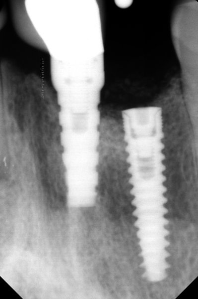 Sybron Anatomic view 2
