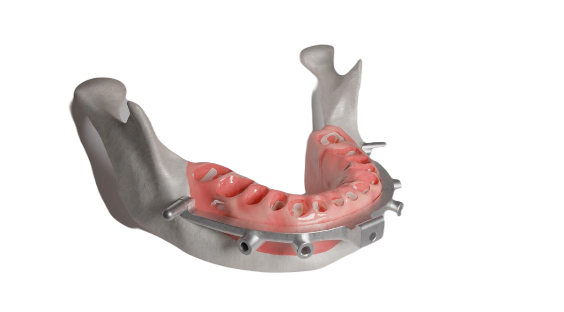 X chrome stackable precision guide for dentist lab bone reduction 2