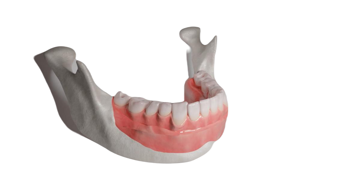 X chrome stackable precision guide for dentist prosthetic