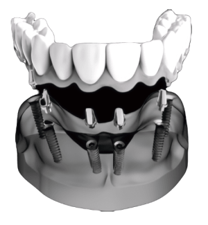 Implant-Supported-Prosthesis- Implant-Supported-Prosthesis-
