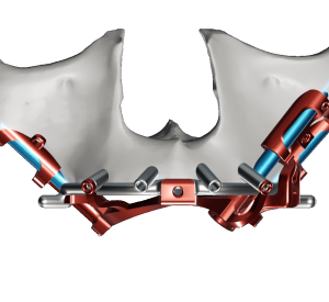 ZYGOMATIC BOTH SIDES WITH BONE ZYGOMATIC BOTH SIDES WITH BONE
